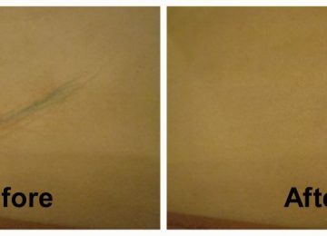 Ink-Removal-2-360x260