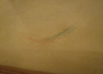 InkRmovalCloseUpBefore-360x260